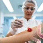Zdravstveni djelatnik u sterilnim uvjetima primjenjuje napredni gel za kemijski debridement kod teško cijeleće rane.